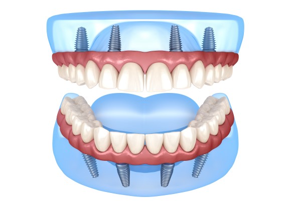 How All On   Is A Recommended Solution For Tooth Loss